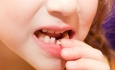اهمیت دندان شیری و تاثیر آنها روی دندان های دائمی چیست